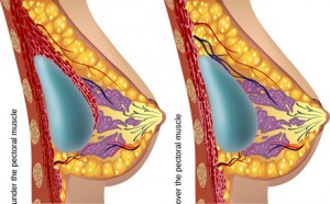 Platzierung der Silikonimplantate bei der Brustvergrößerung